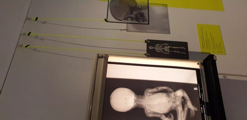Pathologisch-Anatomische Sammlung Im Narrenturm