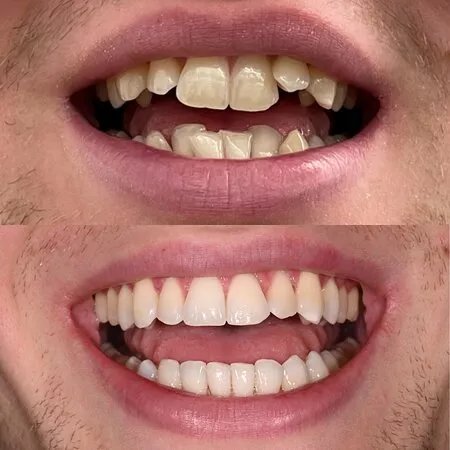 Alpine Smiles
